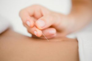 dry-needle-therapy-acupuncture