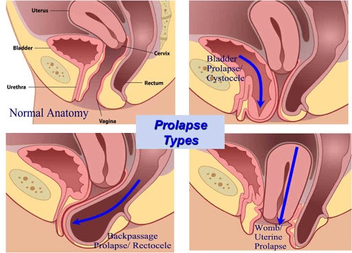 organ prolapse types