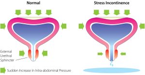 Stress-Urinary-incontinence-diagram