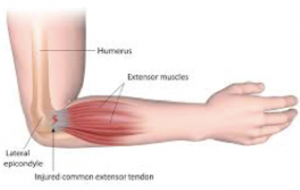 Tennis Elbow – What is it and what can you do about it