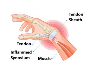Wrist Pain. How to treat it
