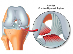 acl-injury-moi